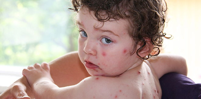 Chicken pox in children