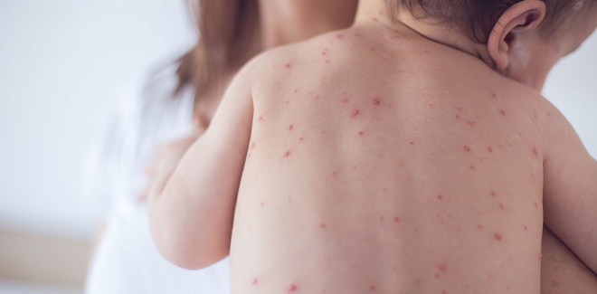 Skin rashes in children