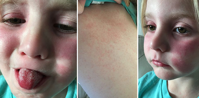 What causes scarlet fever in a child